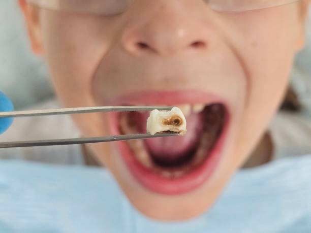 Best Emergency Dentist for Lost Fillings or Crowns in USA
